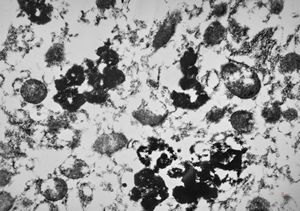 M,66y. | siderosomes M,66y. | siderosomes